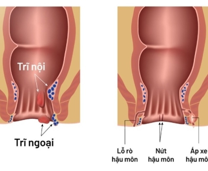 Phân biệt giữa bệnh trĩ và các bệnh lý như nứt kẽ hậu môn hay áp xe hậu môn